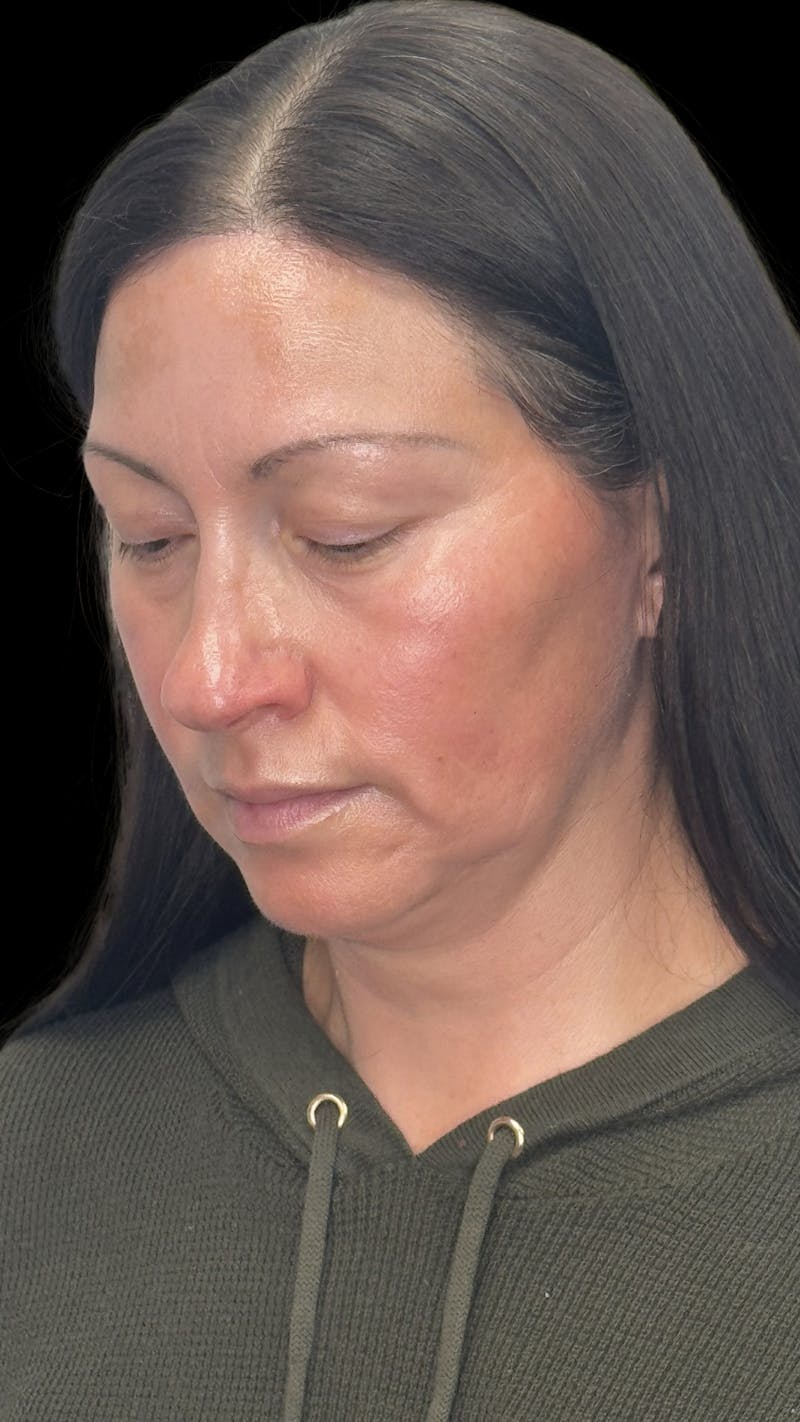 ContourLift Before & After Gallery - Patient 419155 - Image 3