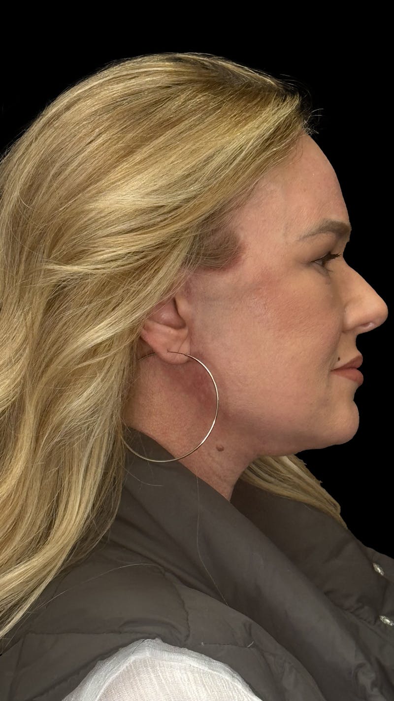 ContourLift Before & After Gallery - Patient 279281 - Image 6