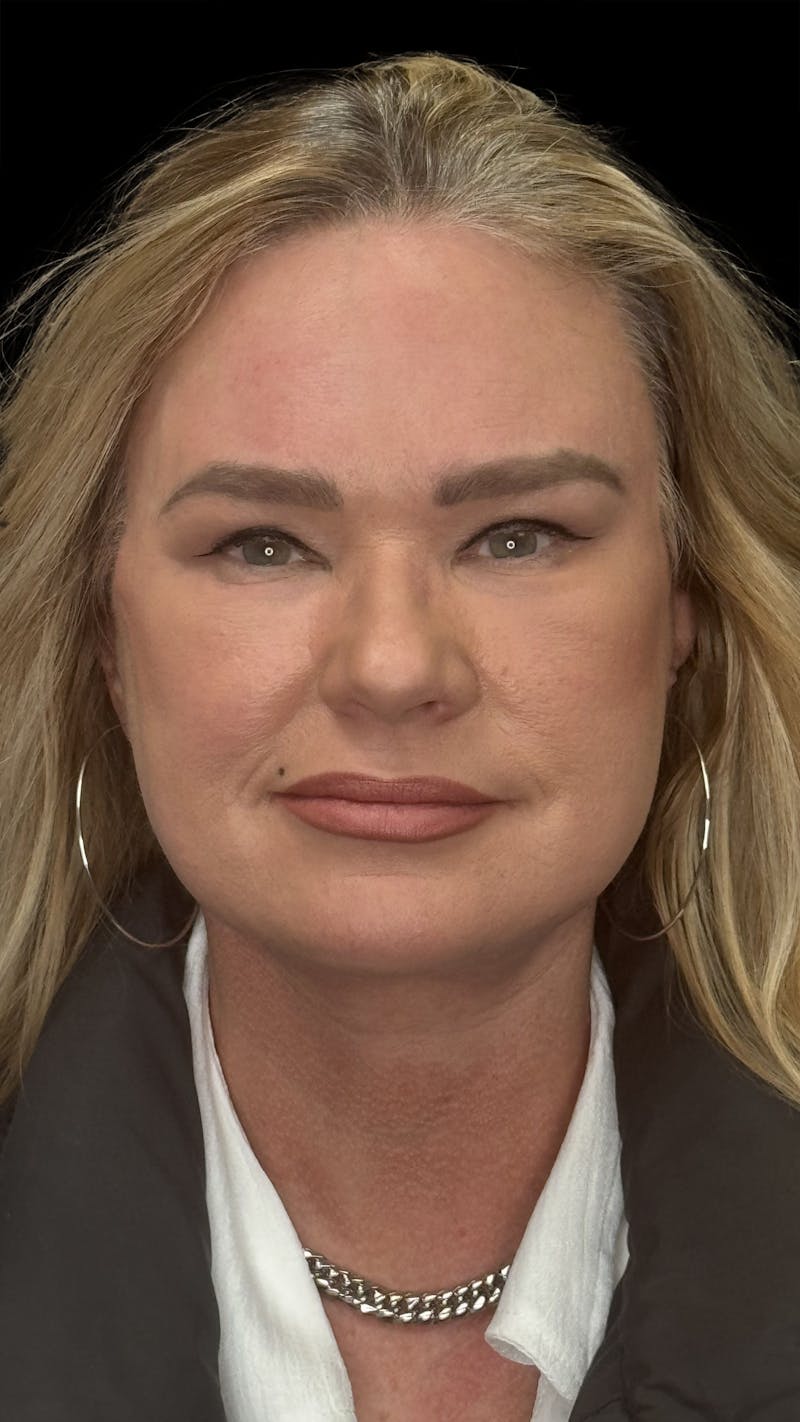ContourLift Before & After Gallery - Patient 279281 - Image 2