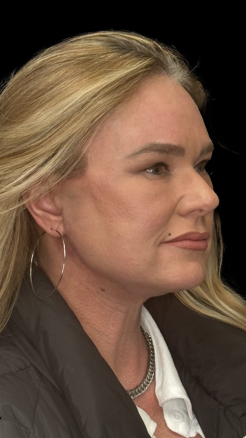 ContourLift Before & After Gallery - Patient 279281 - Image 4