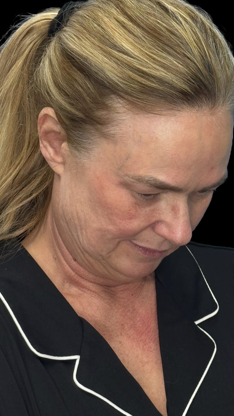 ContourLift Before & After Gallery - Patient 279281 - Image 8
