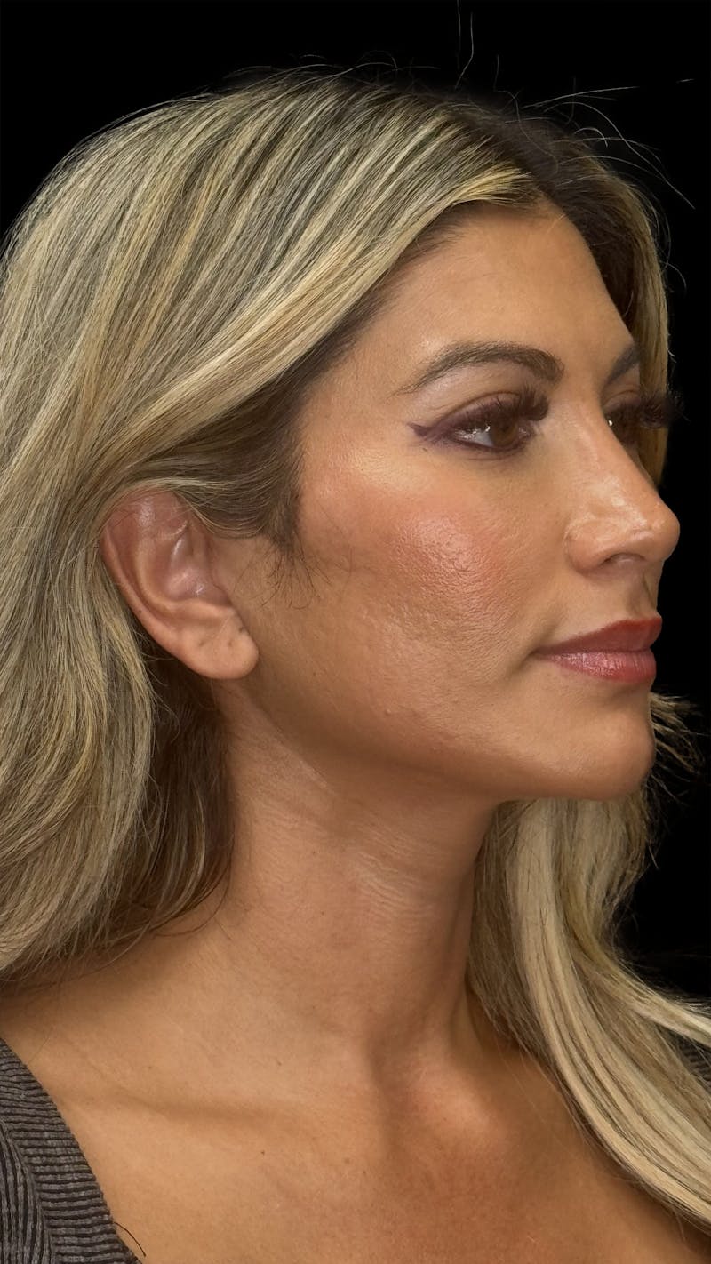 ContourLift Before & After Gallery - Patient 140441 - Image 10