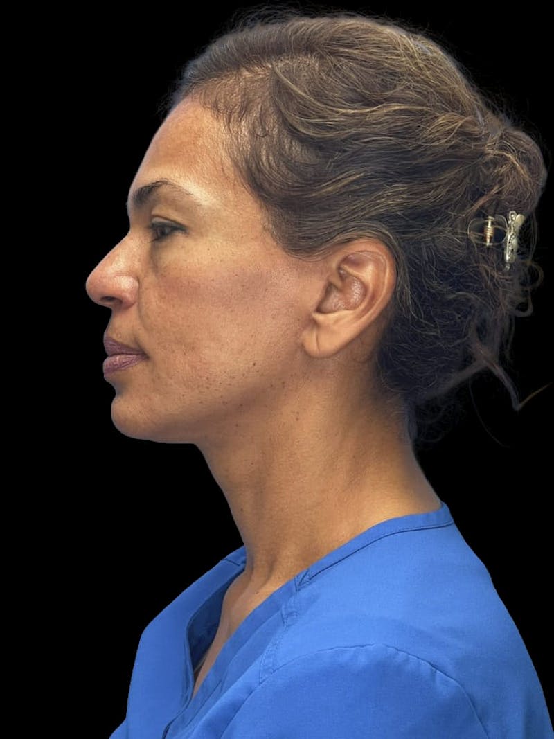 Deep Plane Facelift 40s Before & After Gallery - Patient 267273 - Image 10