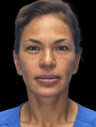 Deep Plane Facelift 40s Before & After Gallery - Patient 267273 - Image 2