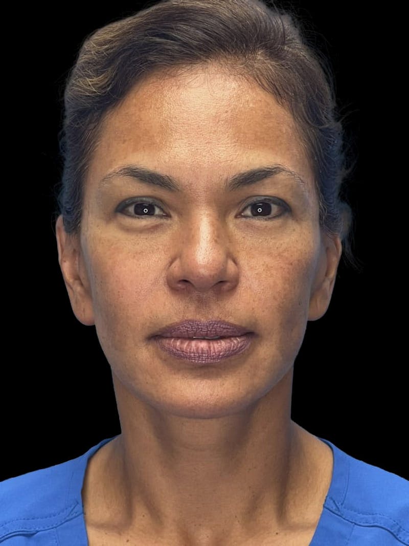 Deep Plane Facelift 40s Before & After Gallery - Patient 267273 - Image 2