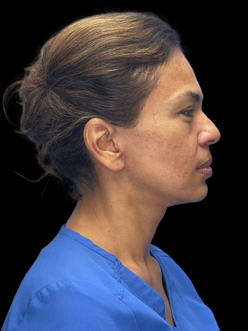 Deep Plane Facelift 40s Before & After Gallery - Patient 267273 - Image 5