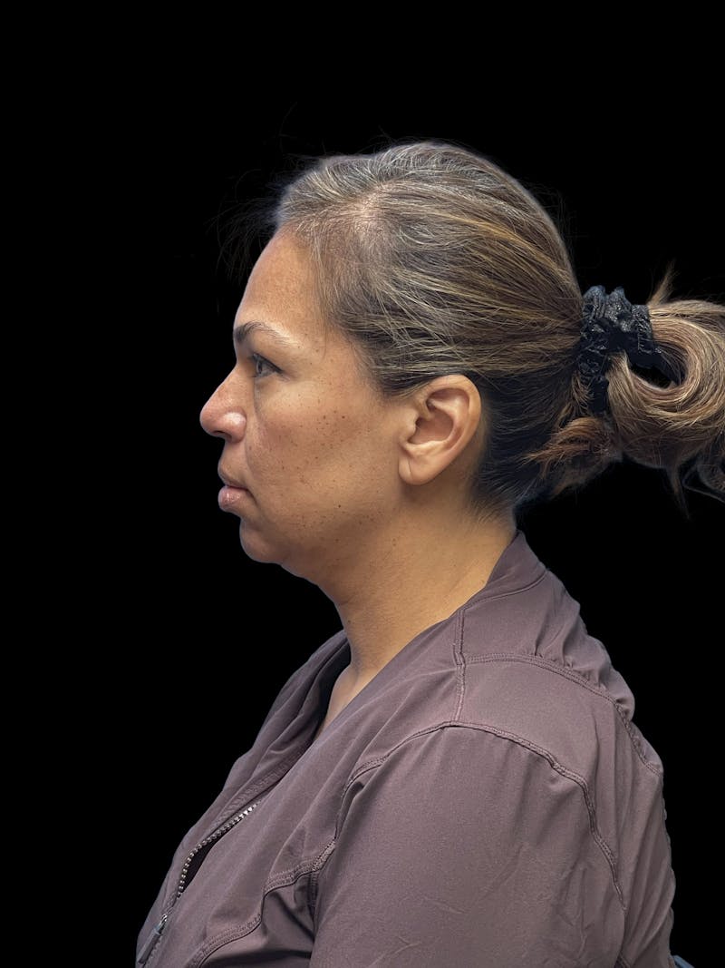 Deep Plane Facelift 40s Before & After Gallery - Patient 267273 - Image 9