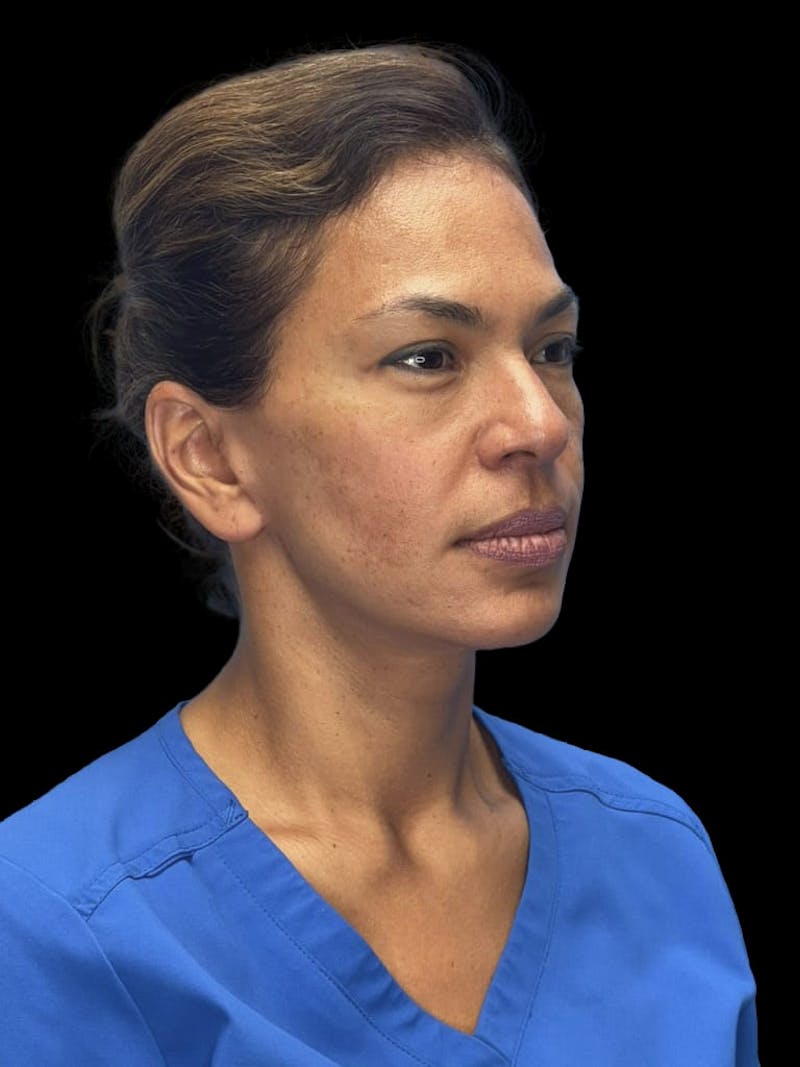 Deep Plane Facelift 40s Before & After Gallery - Patient 267273 - Image 4