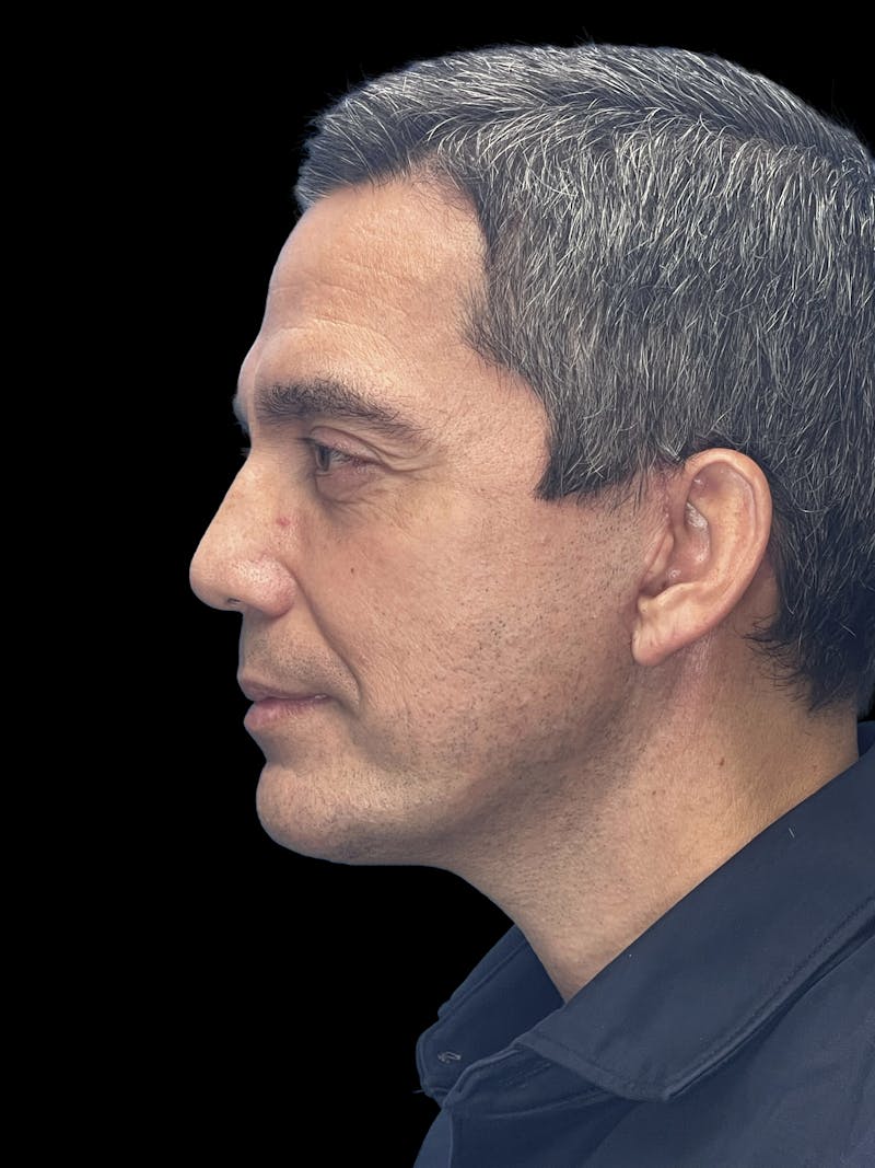 ContourLift Before & After Gallery - Patient 868892 - Image 6