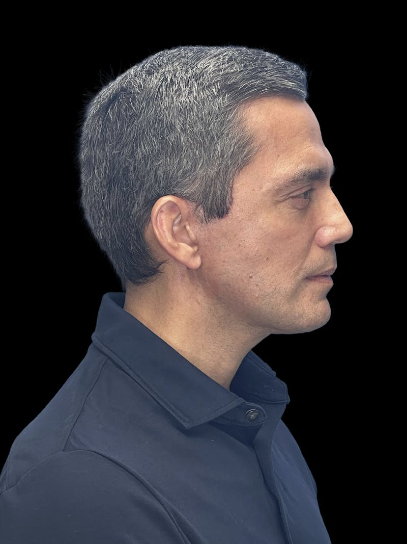 ContourLift Before & After Gallery - Patient 868892 - Image 10