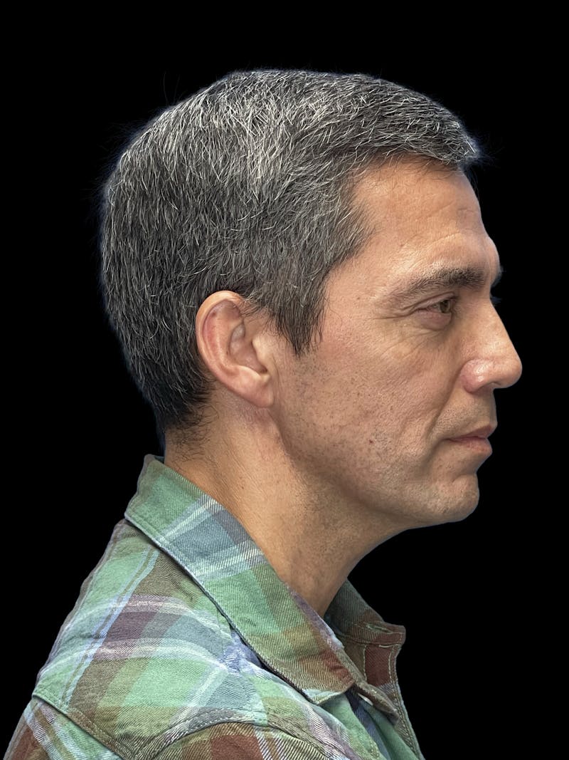 ContourLift Before & After Gallery - Patient 868892 - Image 9