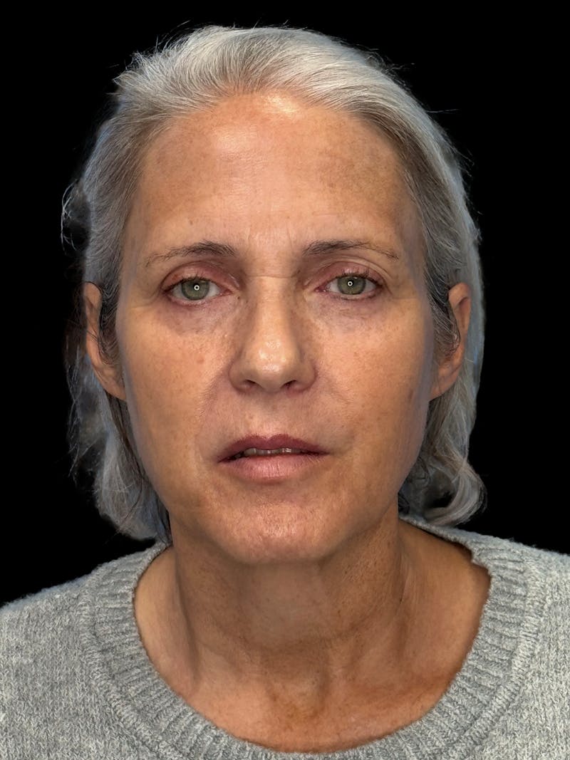 ContourLift Before & After Gallery - Patient 331359 - Image 1