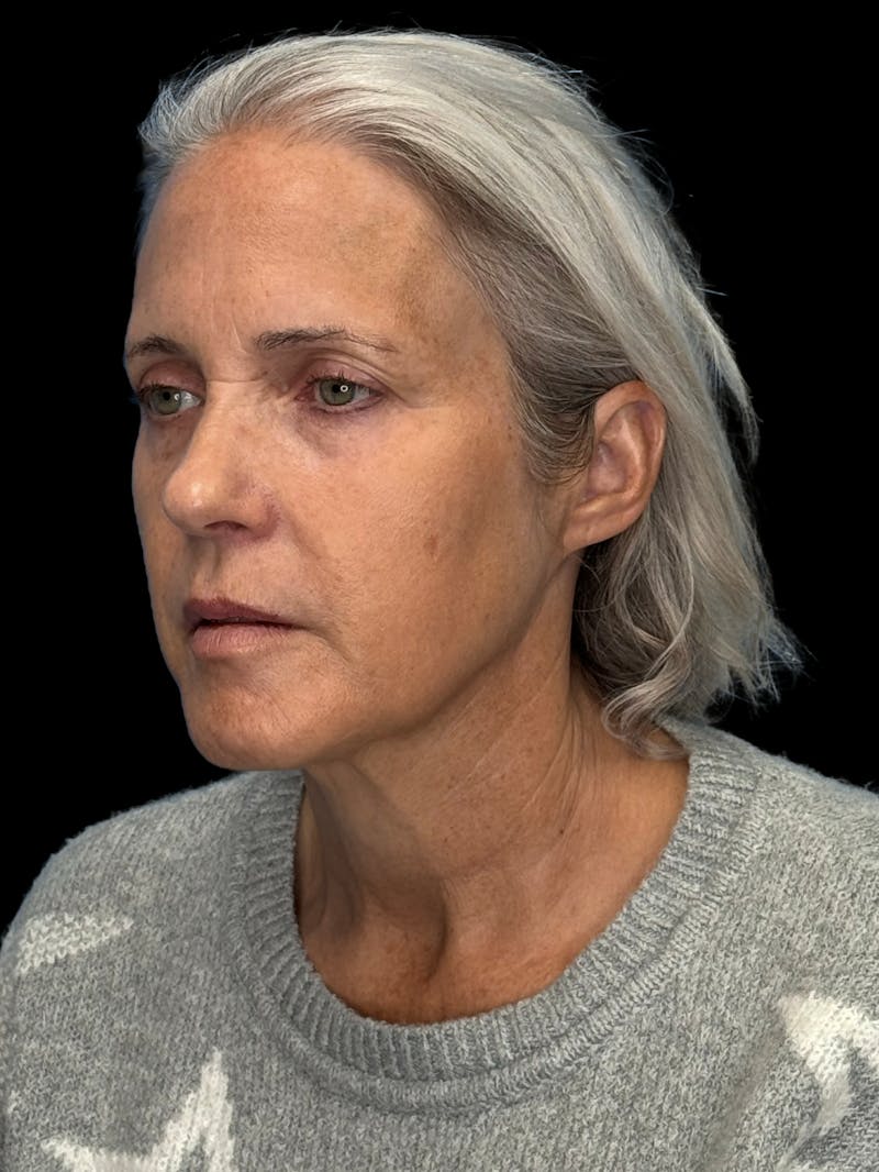 ContourLift Before & After Gallery - Patient 331359 - Image 3