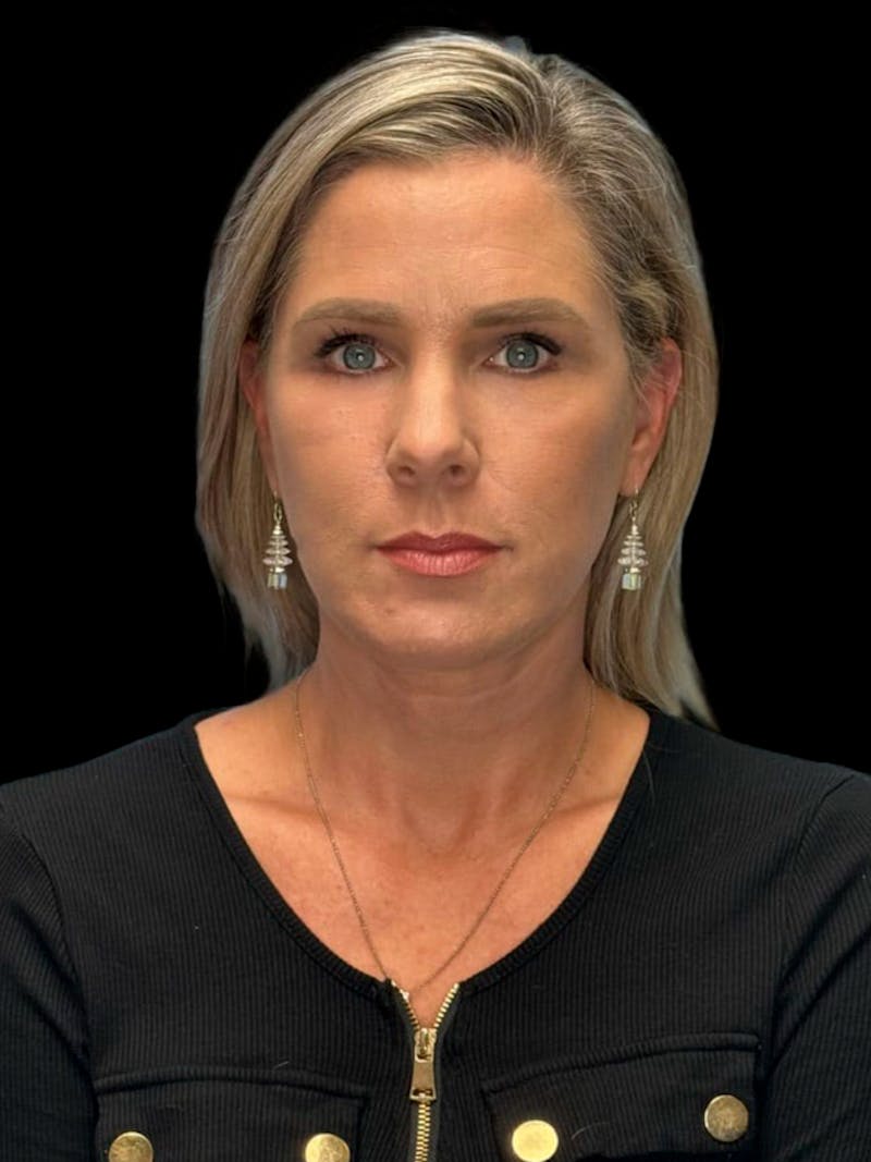 Deep Plane Facelift 40s Before & After Gallery - Patient 319525 - Image 2
