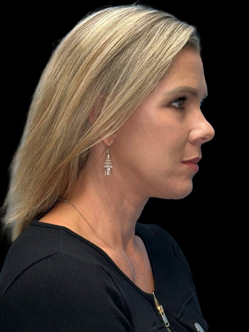 Deep Plane Facelift 40s Before & After Gallery - Patient 319525 - Image 6