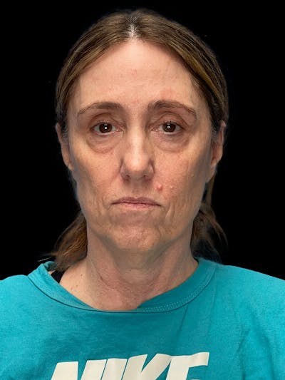Deep Plane Facelift 40s Before & After Gallery - Patient 229141 - Image 1