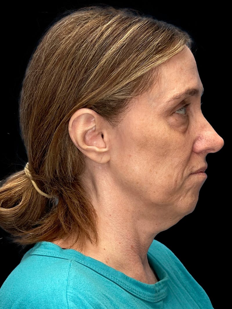 Deep Plane Facelift 40s Before & After Gallery - Patient 229141 - Image 7