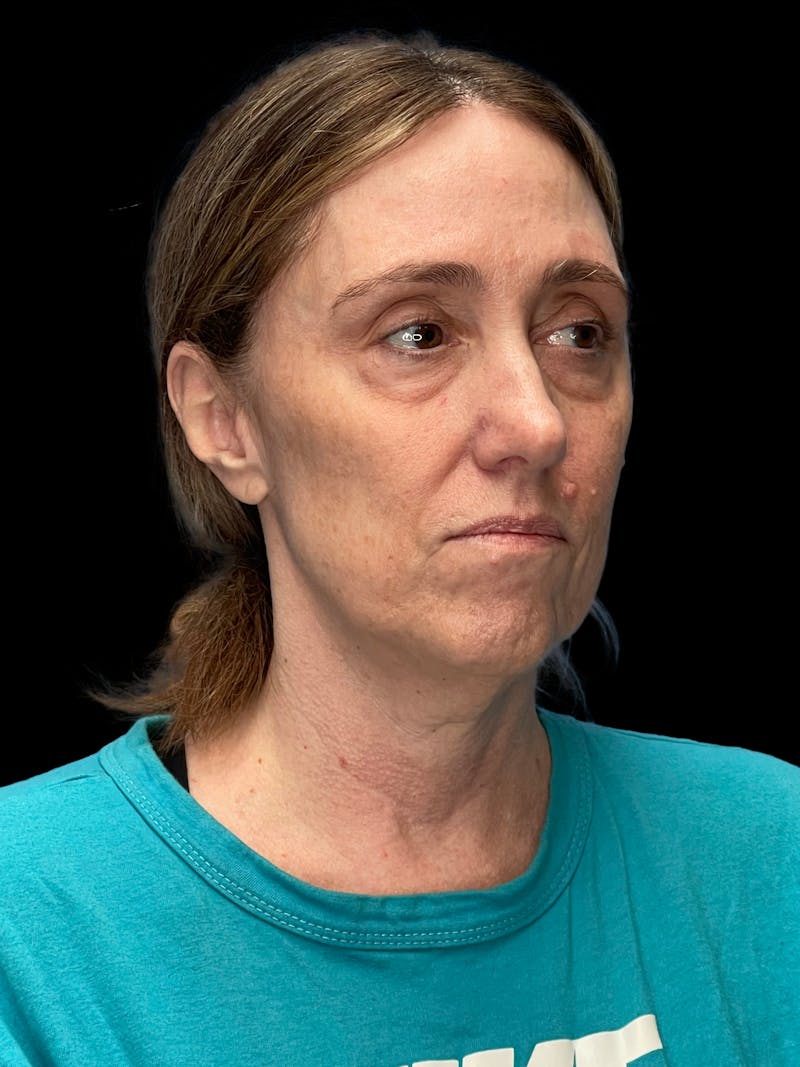 Deep Plane Facelift 40s Before & After Gallery - Patient 229141 - Image 5