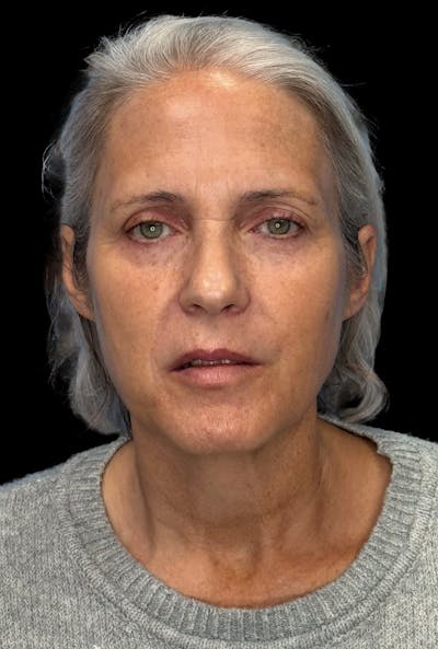 Deep Plane Facelift 50s Before & After Gallery - Patient 400682 - Image 1