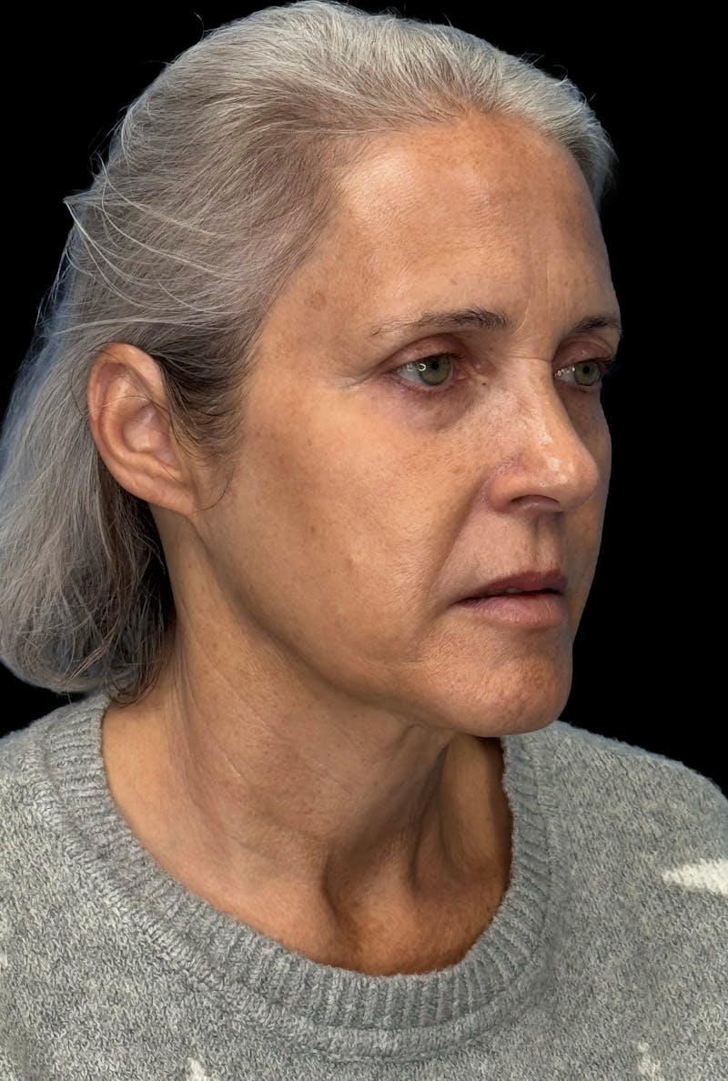 Deep Plane Facelift 50s Before & After Gallery - Patient 400682 - Image 3