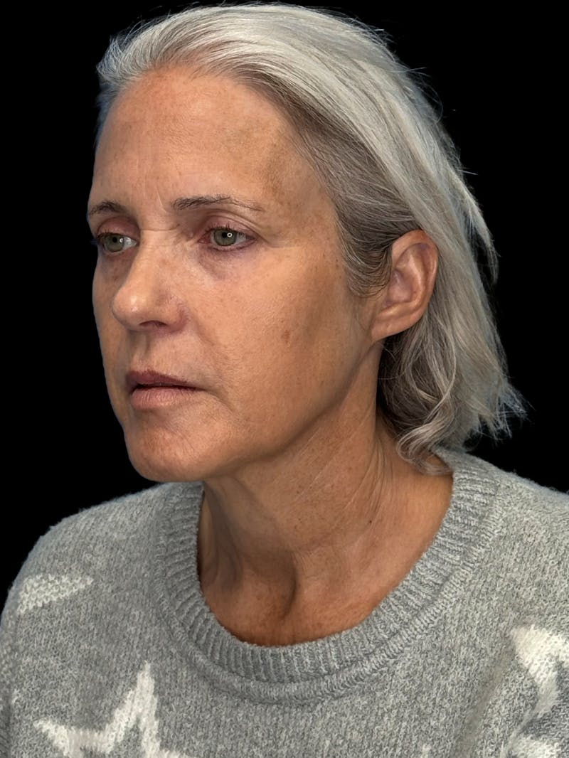 Deep Plane Facelift 50s Before & After Gallery - Patient 400682 - Image 7