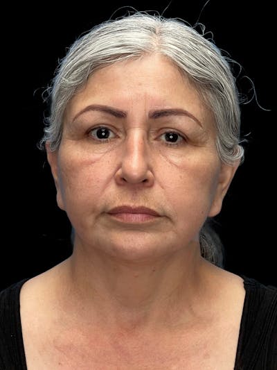 Deep Plane Facelift 60s Before & After Gallery - Patient 238800 - Image 1