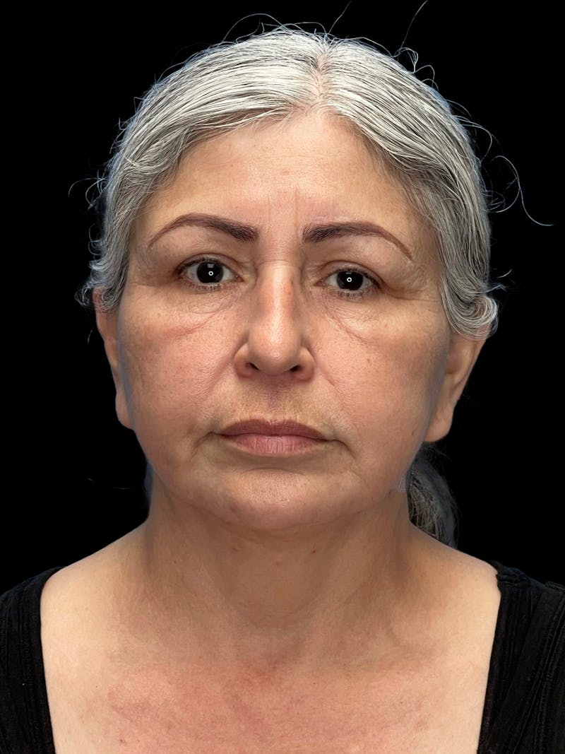 Deep Plane Facelift 60s Before & After Gallery - Patient 238800 - Image 1