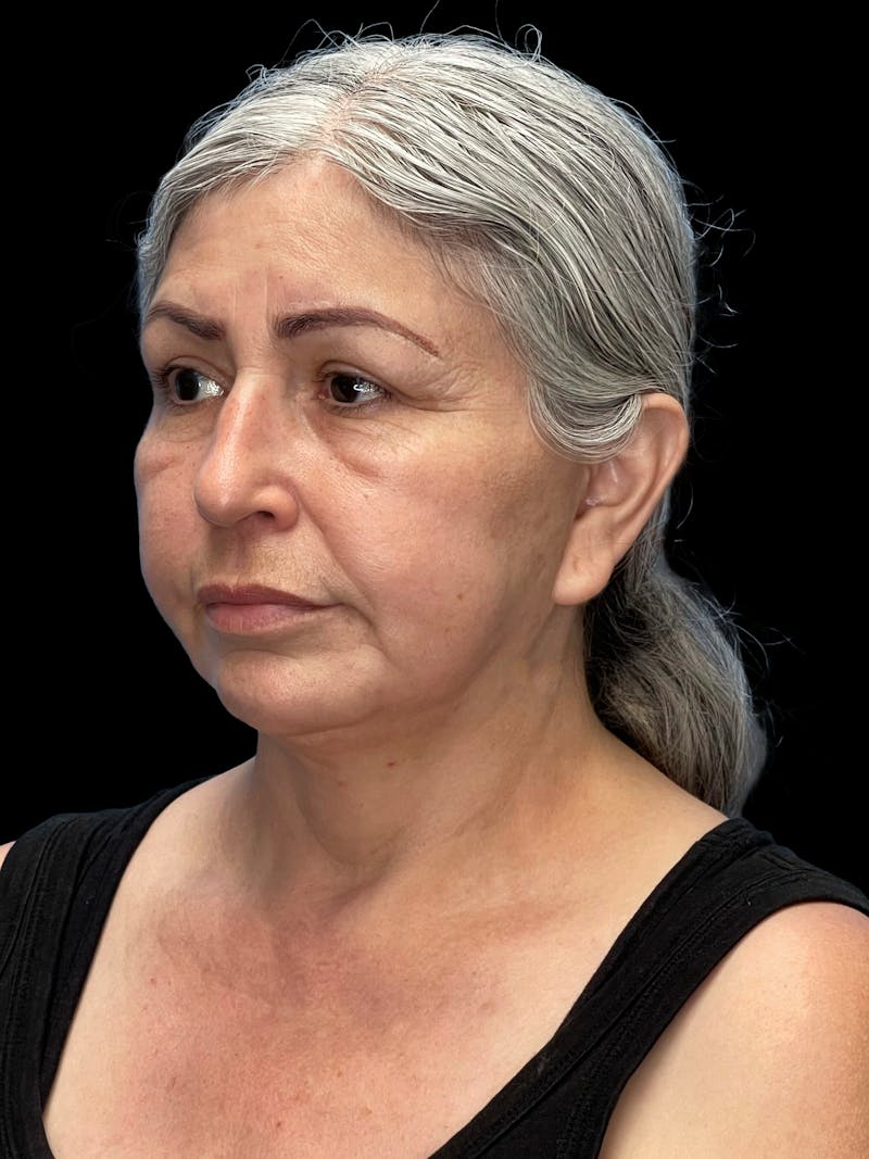 Deep Plane Facelift 60s Before & After Gallery - Patient 238800 - Image 3