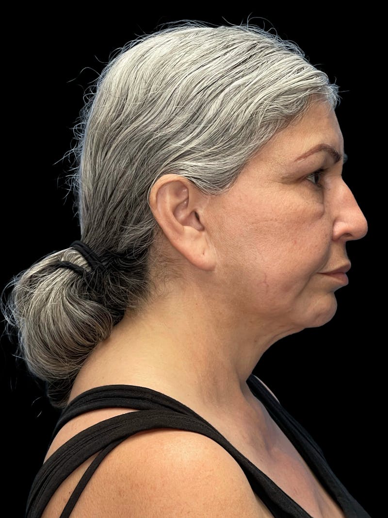 Deep Plane Facelift 60s Before & After Gallery - Patient 238800 - Image 9