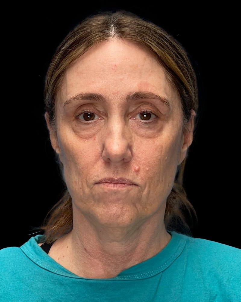 Mini Deep Plane Facelift Before & After Gallery - Patient 506348 - Image 1