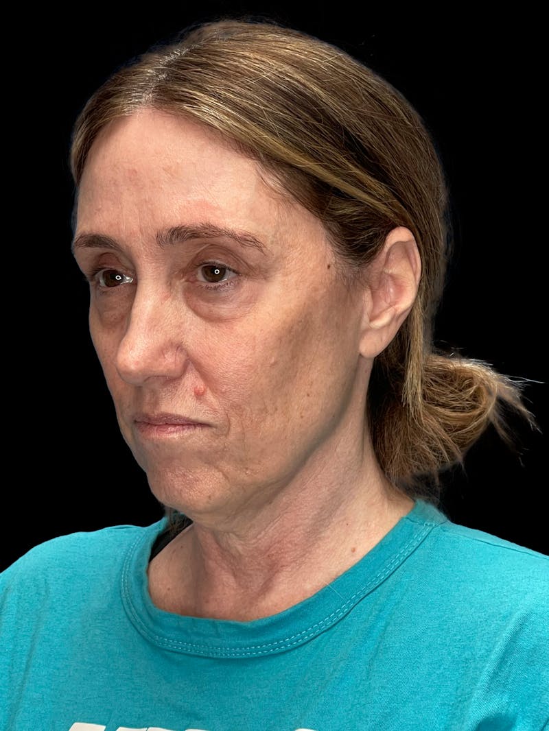 Mini Deep Plane Facelift Before & After Gallery - Patient 506348 - Image 3