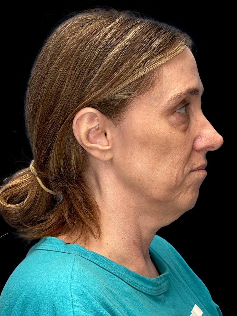 Mini Deep Plane Facelift Before & After Gallery - Patient 506348 - Image 9