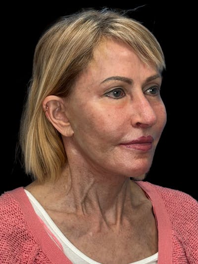 Revision Facelift Before & After Gallery - Patient 974023 - Image 2