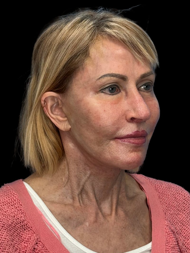 Revision Facelift Before & After Gallery - Patient 974023 - Image 2