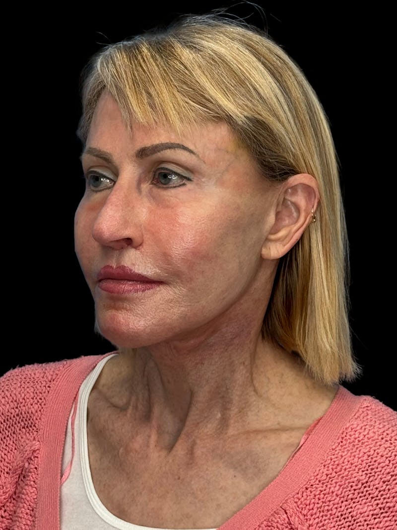 Revision Facelift Before & After Gallery - Patient 974023 - Image 4