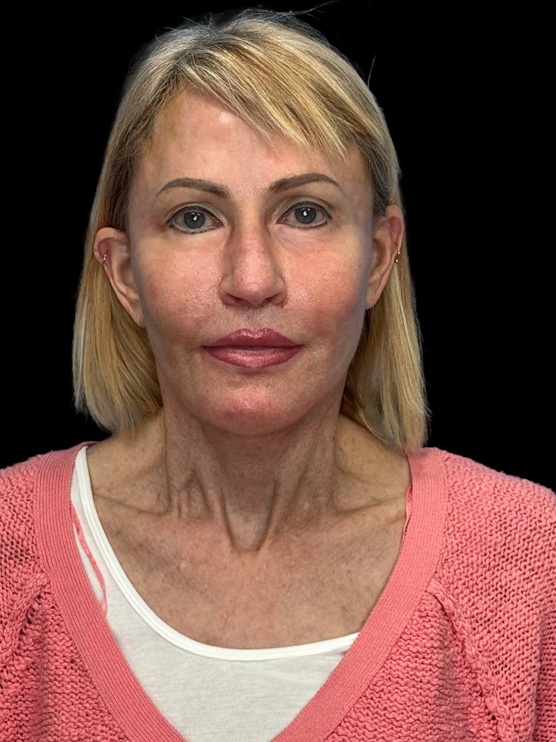 Revision Facelift Before & After Gallery - Patient 974023 - Image 6