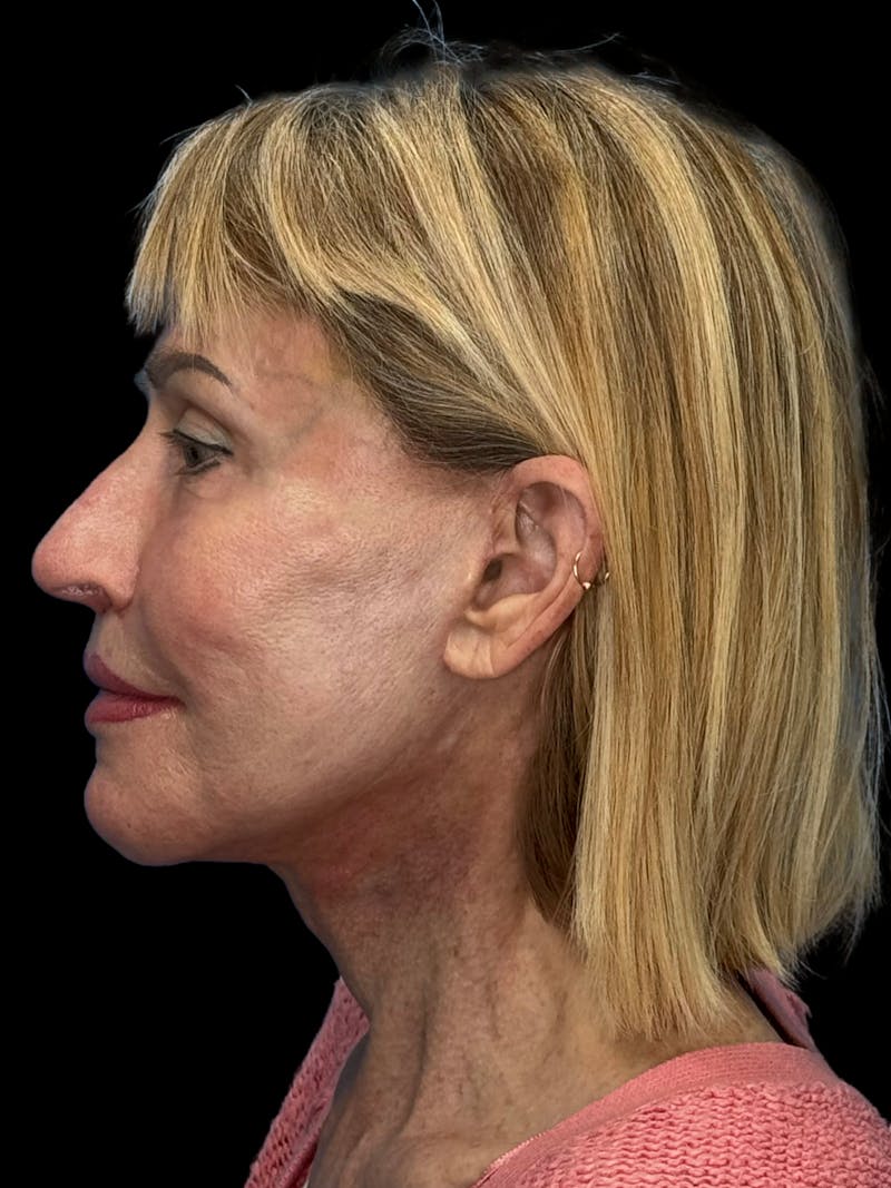Revision Facelift Before & After Gallery - Patient 974023 - Image 8