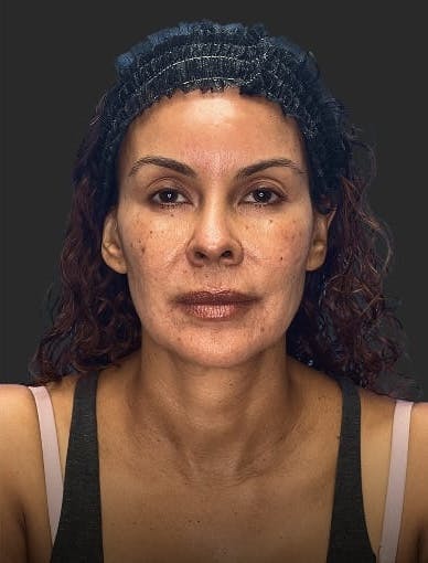 Before image of a woman