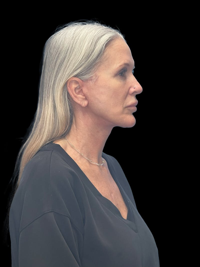 Deep Plane Facelift 50s Before & After Gallery - Patient 292124 - Image 7
