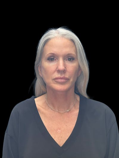 Deep Plane Facelift 50s Before & After Gallery - Patient 292124 - Image 2