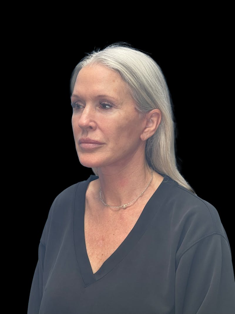 Deep Plane Facelift 50s Before & After Gallery - Patient 292124 - Image 4