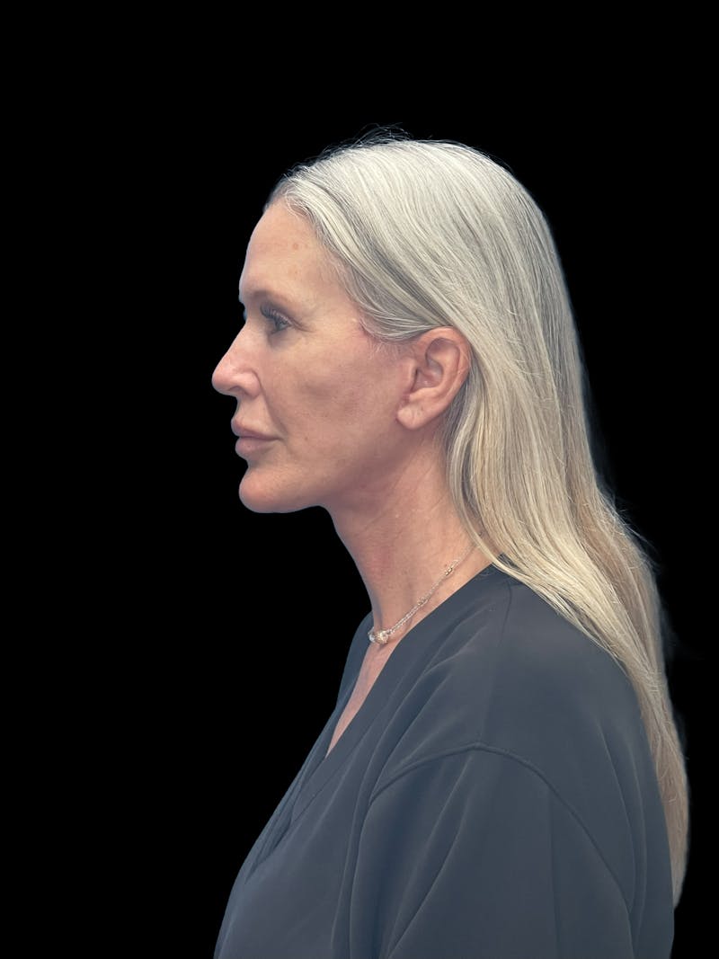 Deep Plane Facelift 50s Before & After Gallery - Patient 292124 - Image 6