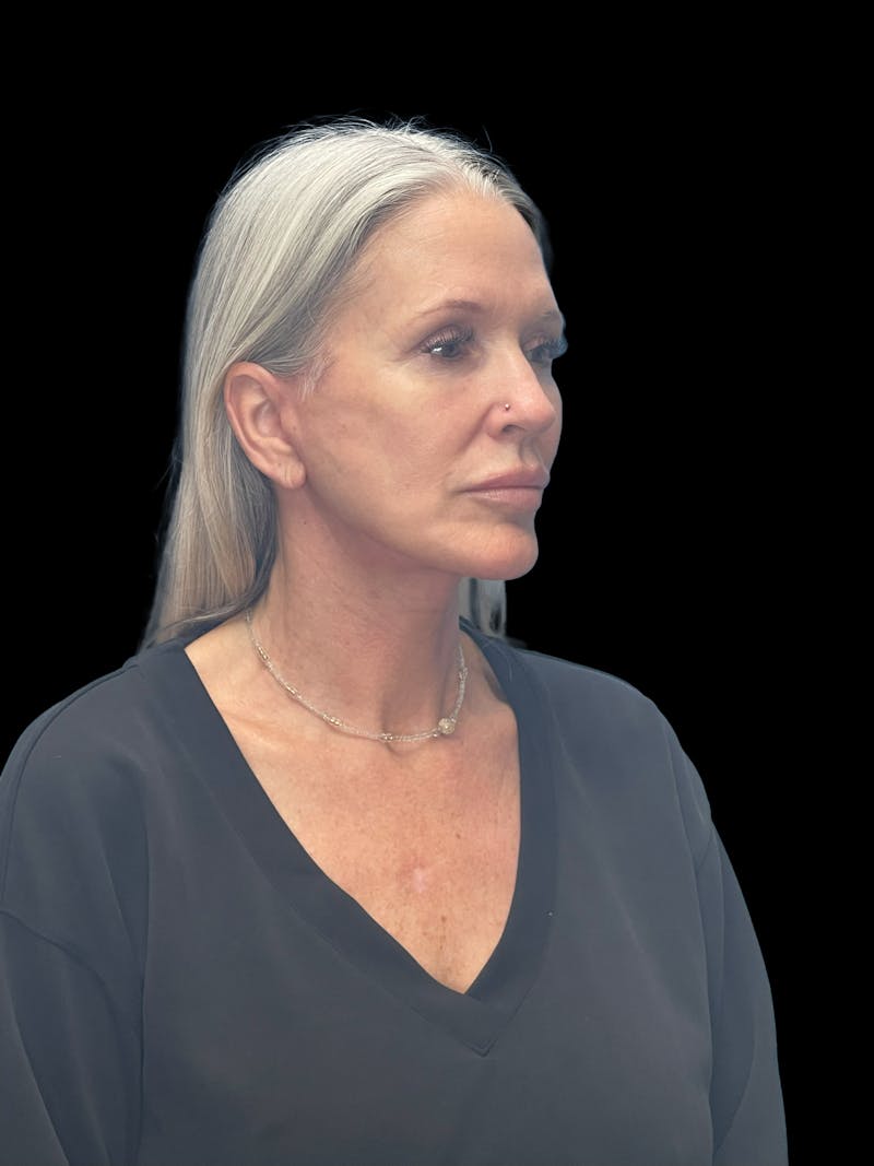Deep Plane Facelift 50s Before & After Gallery - Patient 292124 - Image 9