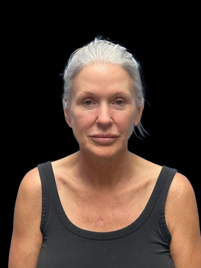 Deep Plane Facelift 50s Before & After Gallery - Patient 292124 - Image 1