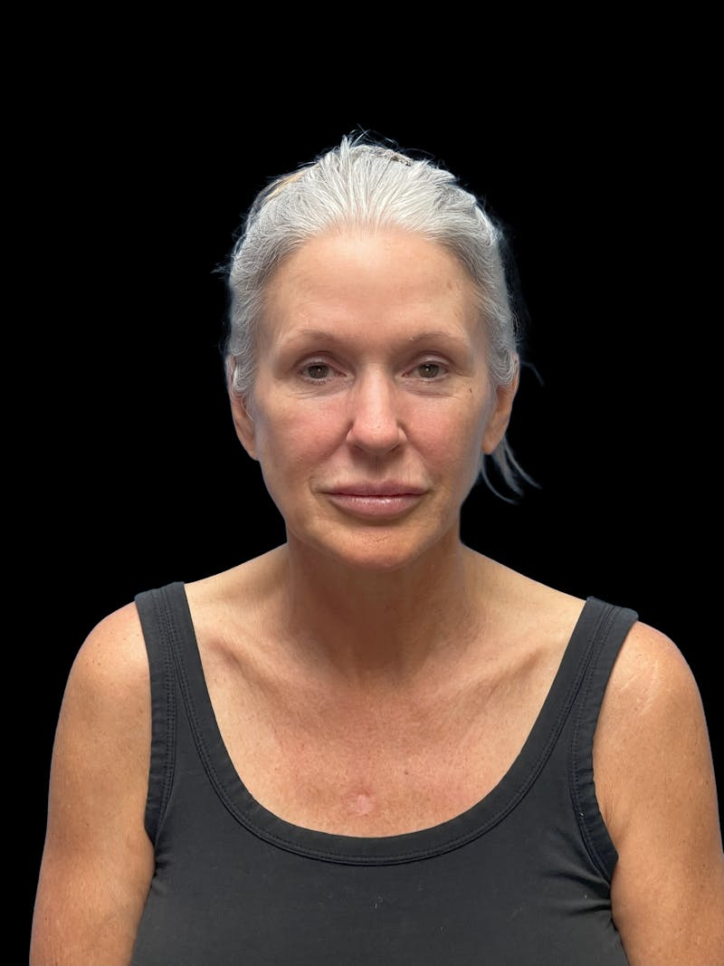 Deep Plane Facelift 50s Before & After Gallery - Patient 292124 - Image 1