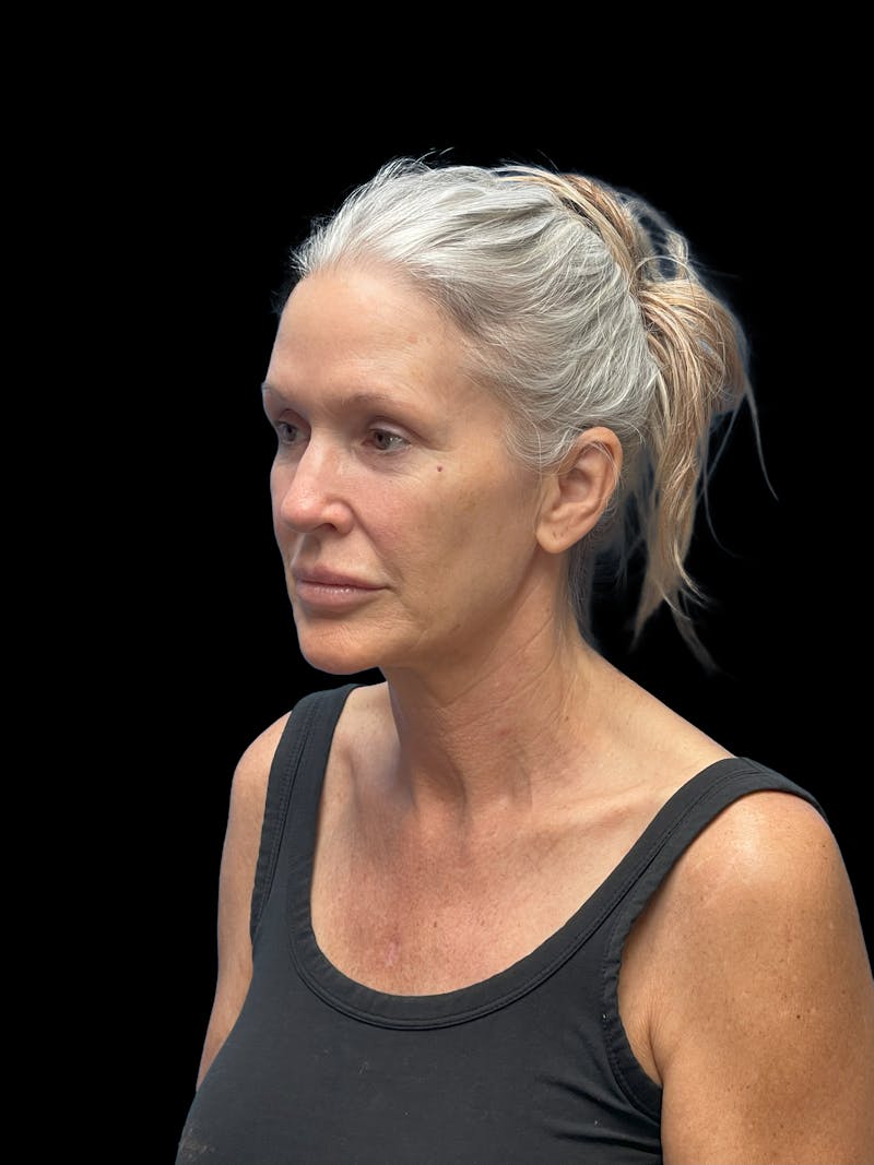 Deep Plane Facelift 50s Before & After Gallery - Patient 292124 - Image 3