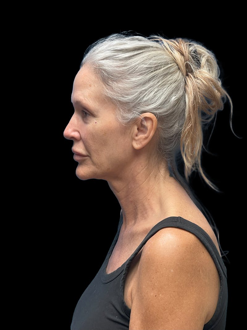 Deep Plane Facelift 50s Before & After Gallery - Patient 292124 - Image 5