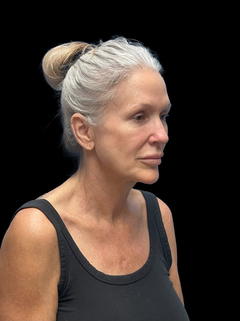 Deep Plane Facelift 50s Before & After Gallery - Patient 292124 - Image 10