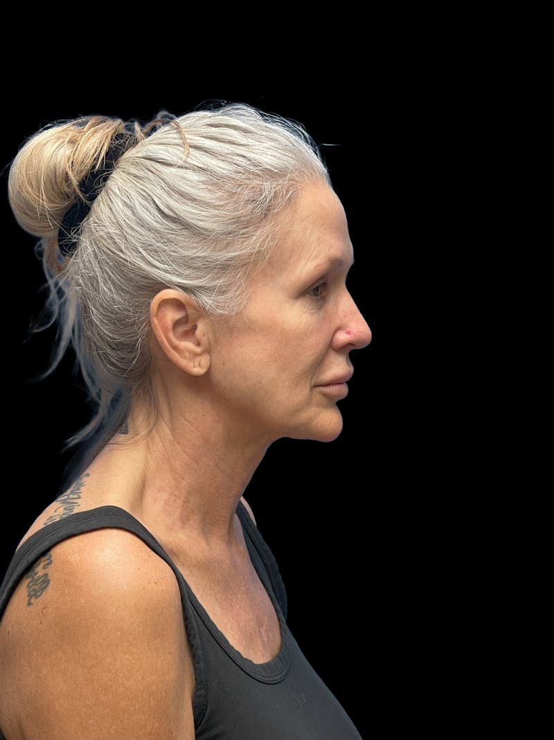 Deep Plane Facelift 50s Before & After Gallery - Patient 292124 - Image 8
