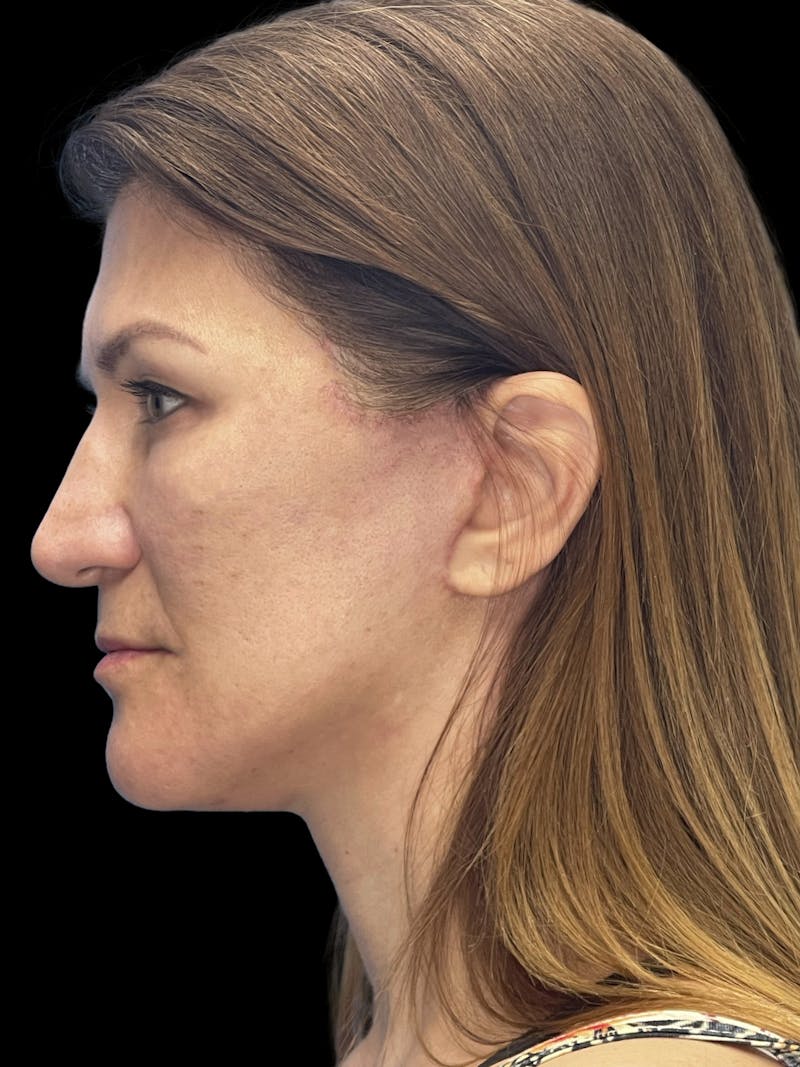 Deep Plane Facelift 50s Before & After Gallery - Patient 194849 - Image 12